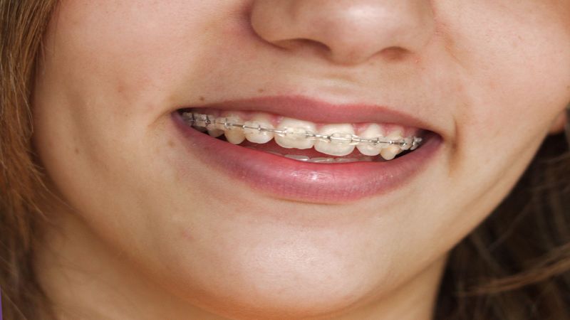 What to Expect from Wisdom Tooth Extraction in Chanhassen, MN